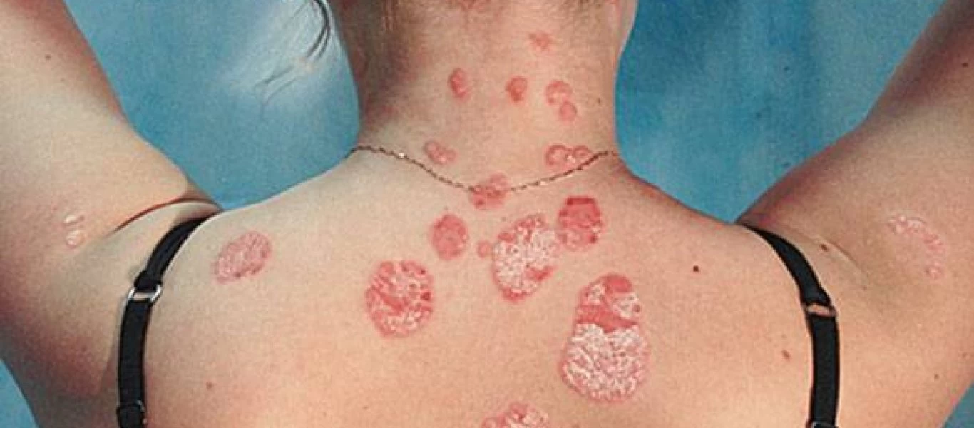 Έχετε ψωρίαση; - Δείτε πως θα την αντιμετωπίσετε